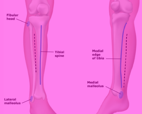 Compartment Syndrome Atlanticcourses